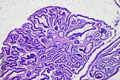 Intestinal adenomatosis photo
