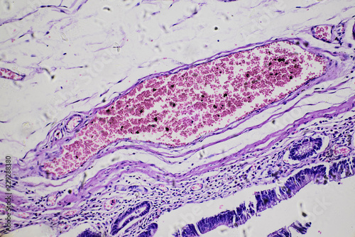 Intestinal adenomatosis