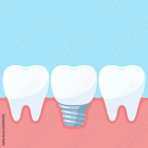 Dental implant, between the normal teeth. Dental clinic services. Vector illustration in flat style