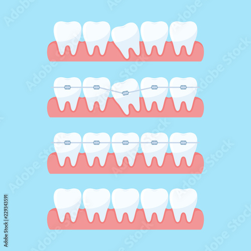 Correction of teeth with orthodontic braces. Stages of teeth alignment, before and after correction with brackets. Dental clinic services. Vector illustration in flat style