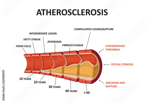 Atherosclerosis - plaque buildup