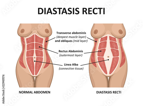 Diastasis recti. Abdominal muscle diastasis after pregnancy pregnancy and childbirth. photo