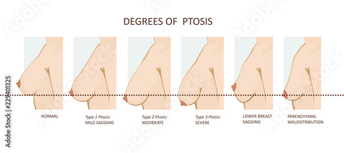 Obraz na plátne Degrees of breast ptosis