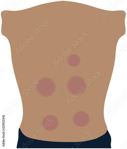Illustration of Skin markings made by medical Vacuum Cupping therapy on back