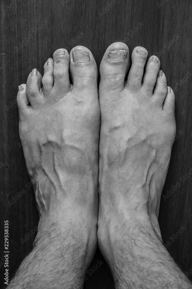 Fototapeta premium onychomycosis with fungal nail infection two feet