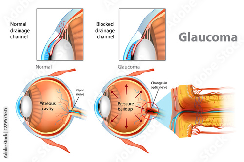 Glaucoma. Illustration showing open-angle glaucoma. Intraocular pressure in the back of the eye photo