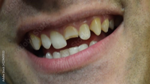 Broken tooth. Broken upper incisor in a man mouth. Man shows oral cavity to the dentist. Treatment of a broken tooth.