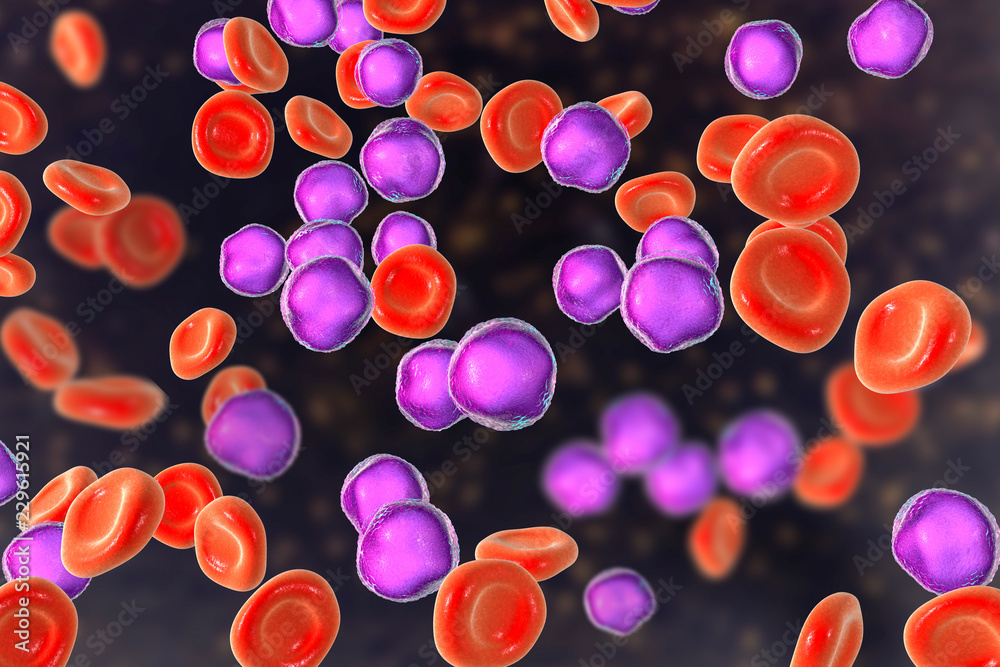 Acute lymphoblastic leukemia, bone marrow smear, 3D illustration
