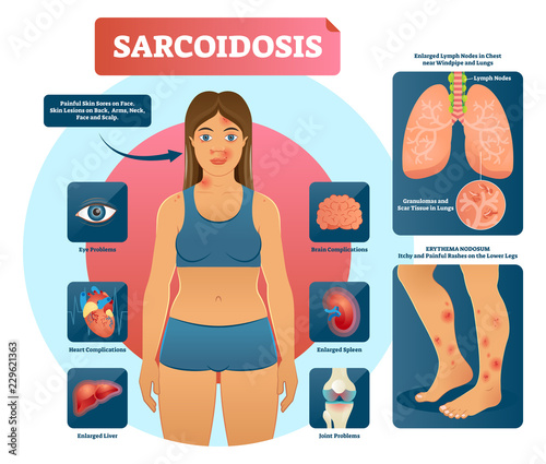 Sarcoidosis vector illustration. Lungs, heart, eyes autoimmune disease