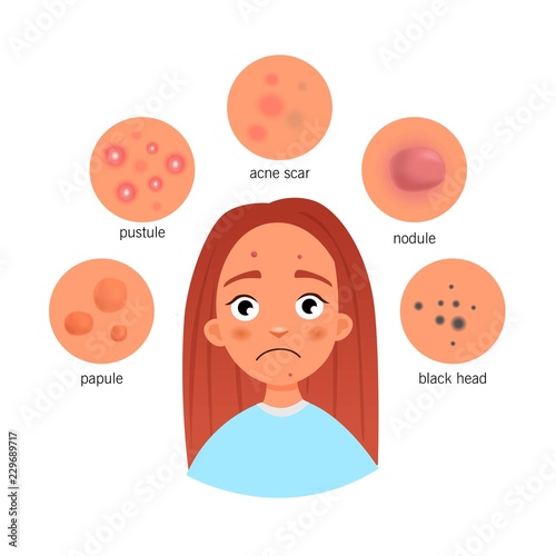 Poster Types of Acne