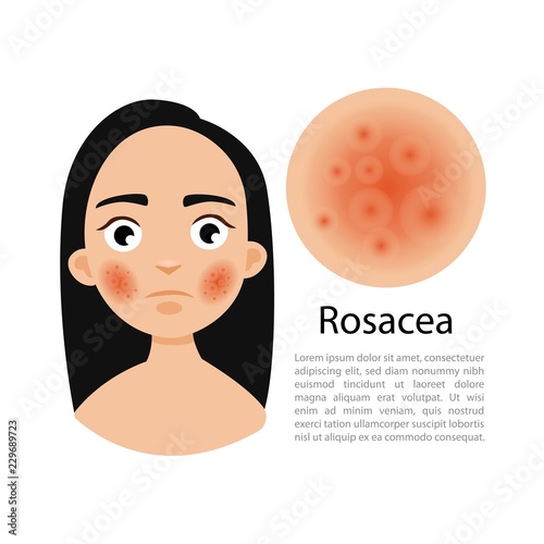 Rosacea. Girl with problem skin