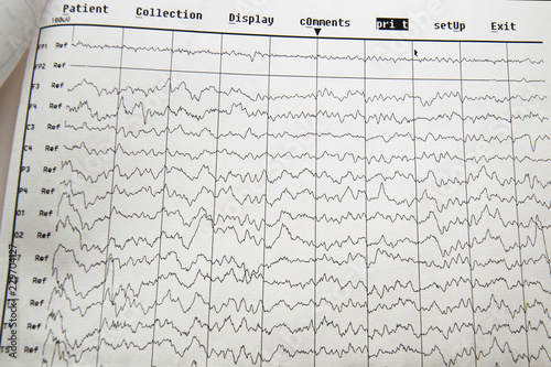 EEG electro physiological monitoring method. EEG wave in human brain, EEG of the child, problems in the electrical activity of the brain