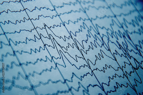 EEG wave in human brain, brain wave patterns on electroencephalogram, problems in the electrical activity of the brain photo