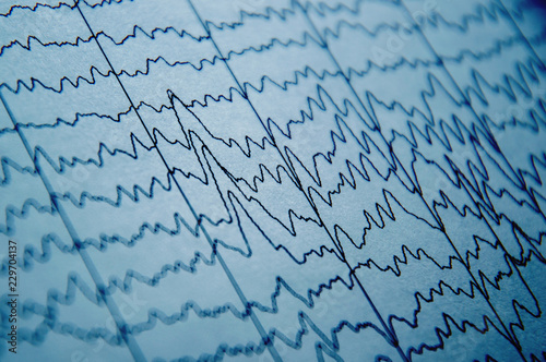EEG wave in human brain, brain wave patterns on electroencephalogram, problems in the electrical activity of the brain