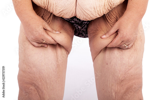 Middle aged women with saggy skin after extreme weight loss