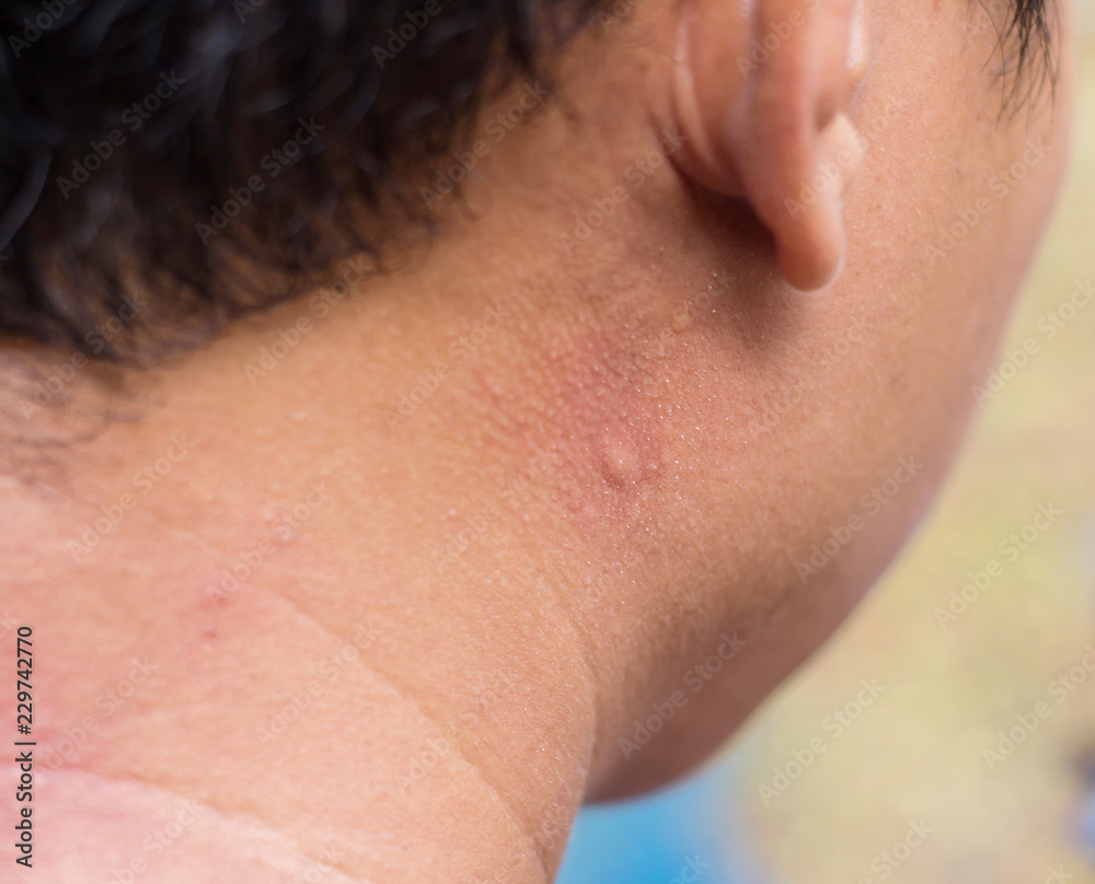 Reddened skin from mosquito bites in nature. Reddened skin from mosquito bites in nature.