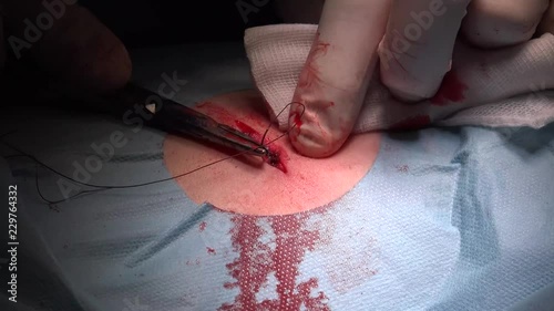Surgical suture commonly called stitches is a medical device used to hold body tissues together after an injury or surgery.