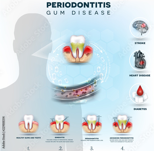 Fototapeta Naklejka Na Ścianę i Meble -  Complications of gum disease, Periodontitis detailed illustration. Bacteria from inflamed gums can enter in to the blood stream and affect other organs such as brain, heart and cause diabetes