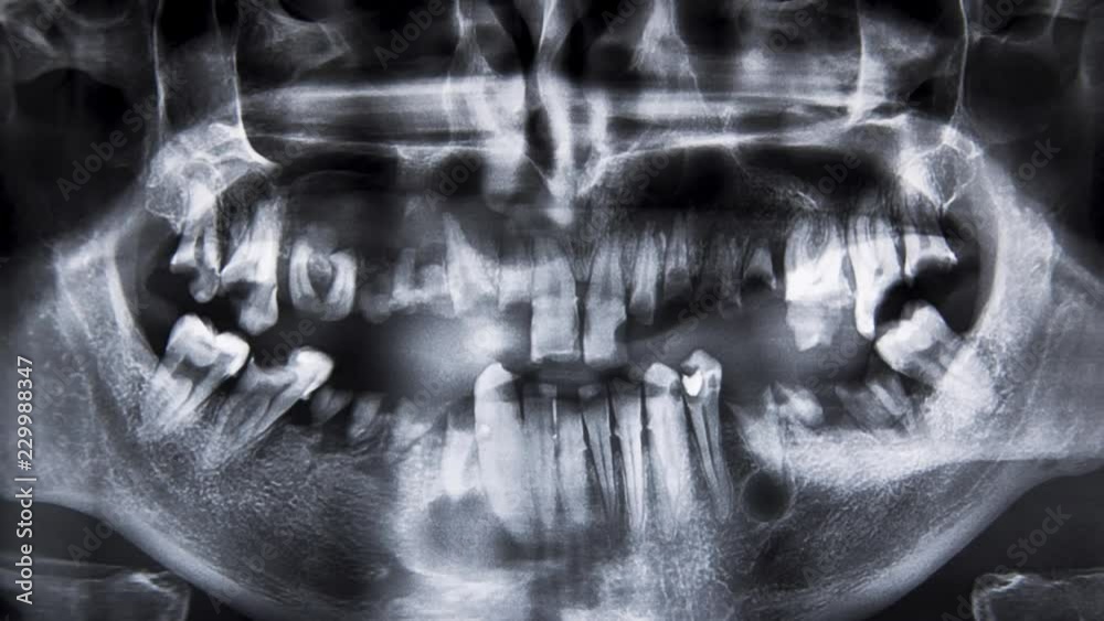 Dental x-ray with bad teeth
