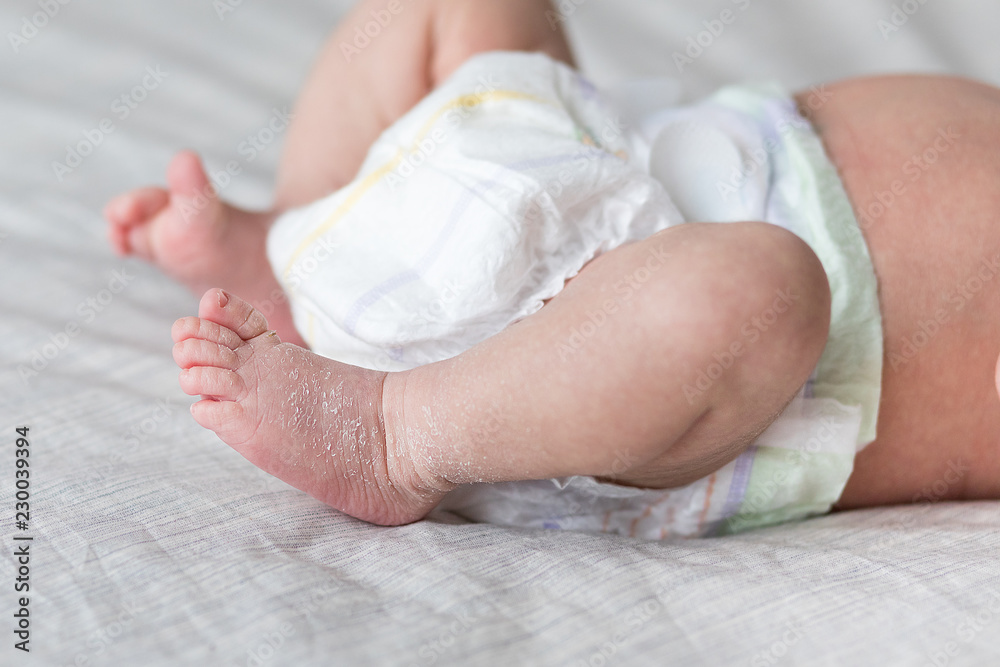 the legs of the newborn baby. the legs of the newborn flaky skin. peel
