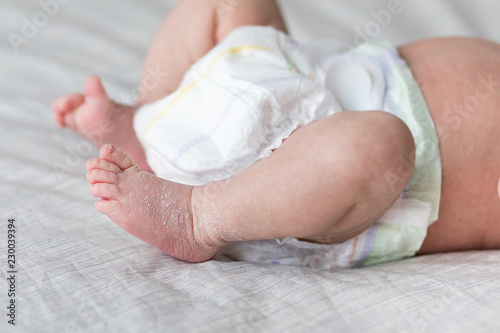 The Legs Of The Newborn Baby The Legs Of The Newborn Flaky Skin Peel Off The Skin Peeling Skin Newborn Newborn Child Feet Stock Photo Adobe Stock