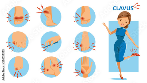 Clavus Skin disorder. Sore feet red shoe on woman's hand touching ankle. Foot and hand wound in a circle. Skin problem icon. pain, swelling, convexity, comic, showing a sick mood. Red markers of pain.