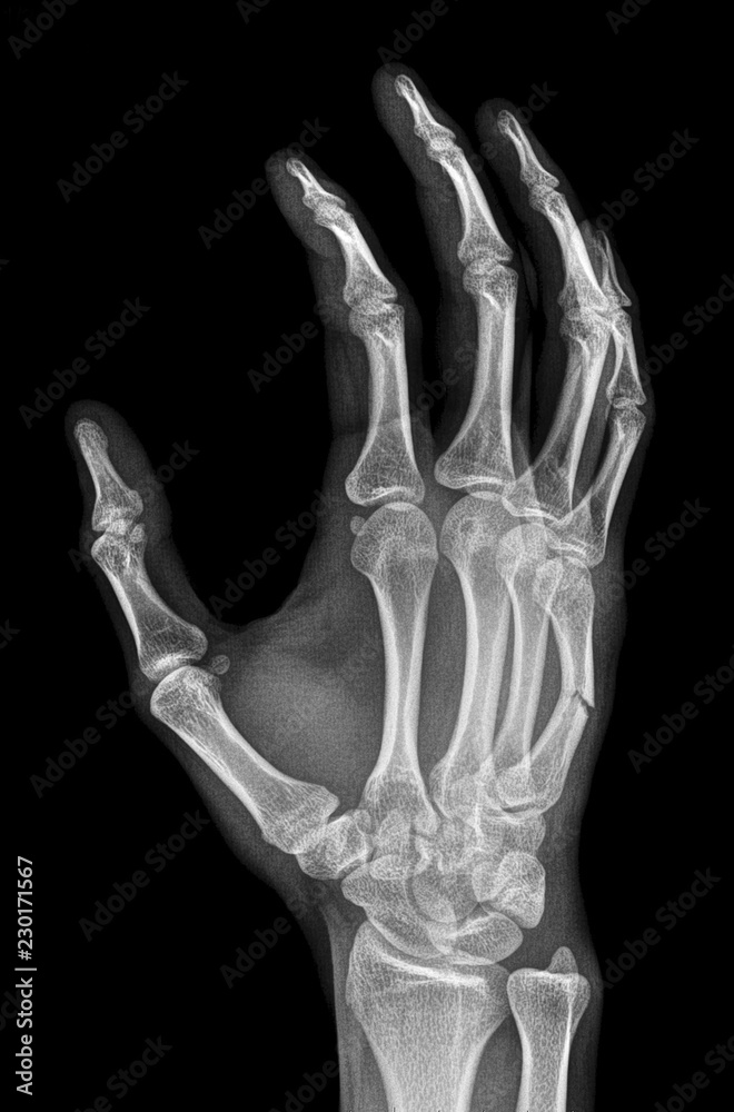 X-ray of fracture of metacarpal bone X-ray of fracture of metacarpal bone