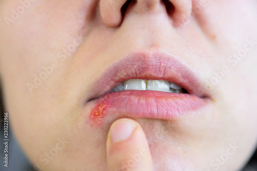 Young woman touching her lip herpes