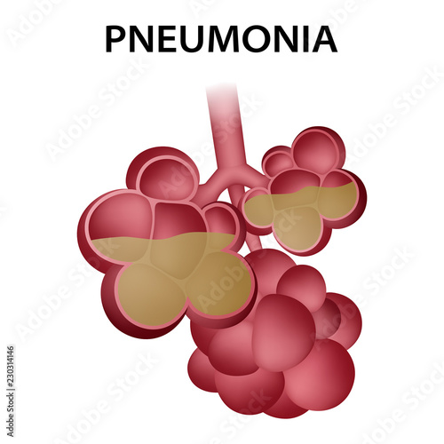 Pneumonia alveoli icon. Realistic illustration of pneumonia alveoli vector icon for web design isolated on white background