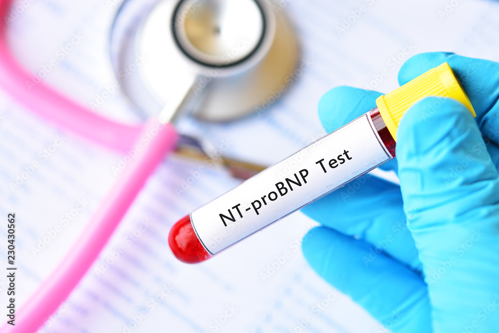 Blood sample for Nterminal pro Btype natriuretic peptide or NTproBNP Blood sample for Nterminal pro Btype natriuretic peptide or NTproBNP
