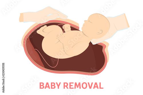 Baby removal stage of birth via cesarean section