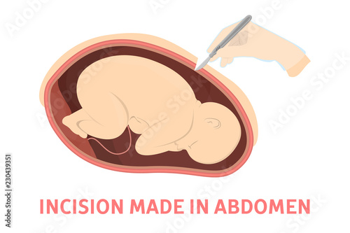Incision making stage of birth via cesarean section