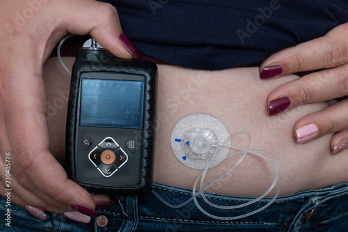 Woman wearing insulin pump to help control her diabetes