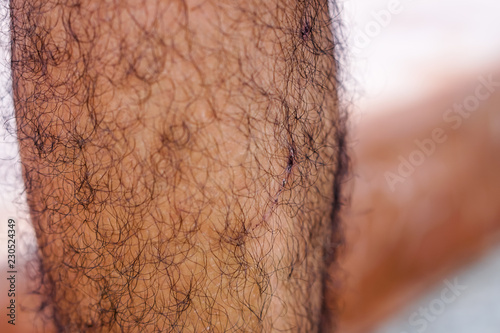 Legs with black hair And there are traces of the wound. Injured. photo