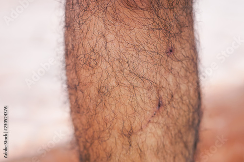 Legs with black hair And there are traces of the wound. Injured.