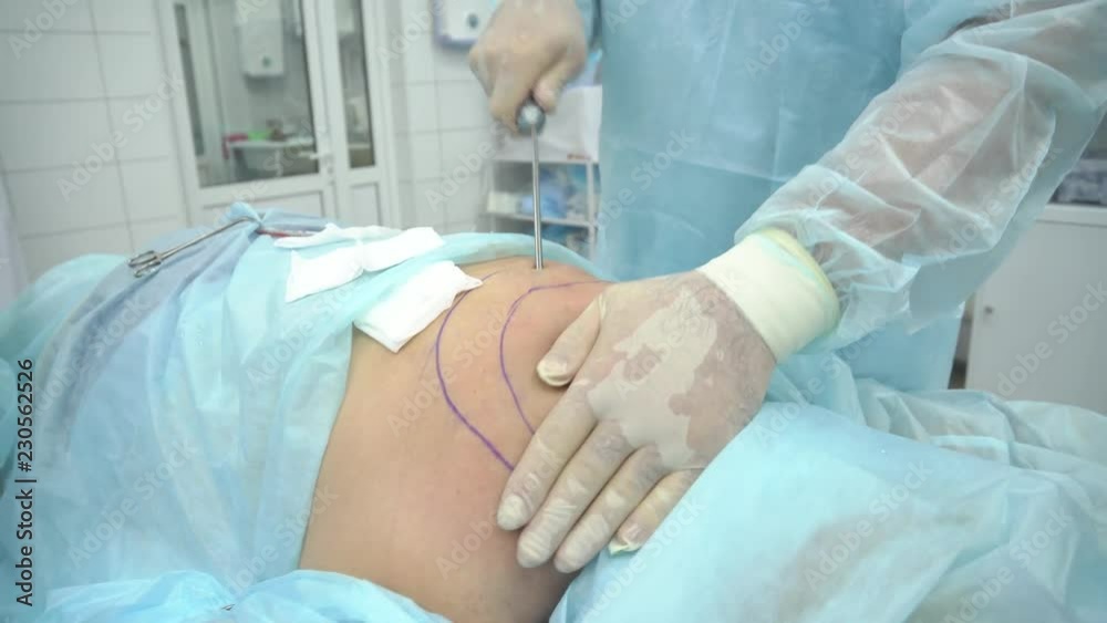 Liposuction operation. Doctor collects fat from the thoracic back