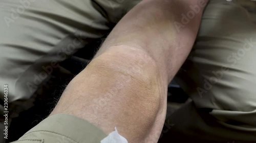 Close up-Orthopedic surgeon injects cortisone in aging baby boomer patients knee to help ease chronic knee pain