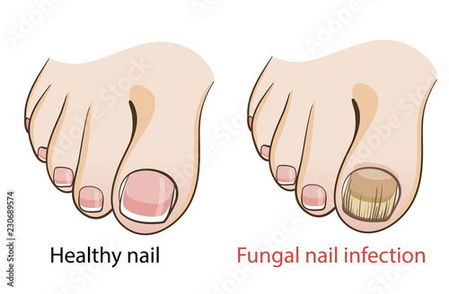Nail fungal infection

