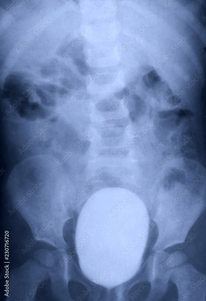 X Ray Contrast Study of Full Bladder of Child Medical Cystography