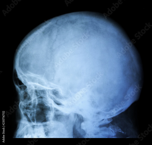 X Ray of Skull - Cranium Medical Analysis - Xray, MRI, CT Diagnostic Scan Photo 