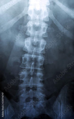 X Ray of Backbone - Human Skeleton Medical Scoliosis or Osteochondrosis Diagnostic Test - Xray, MRI, CT Scan Snapshot
 photo