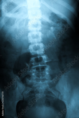 Xray of Pelvic Bones, Vertebra, Ribs - Human Skeleton Medical Scoliosis or Osteochondrosis Detection Test - Xray, MRI, CT Scan Snapshot
