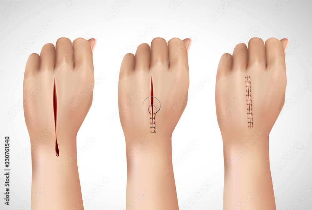 Obraz premium Surgical Stitching Hands Composition