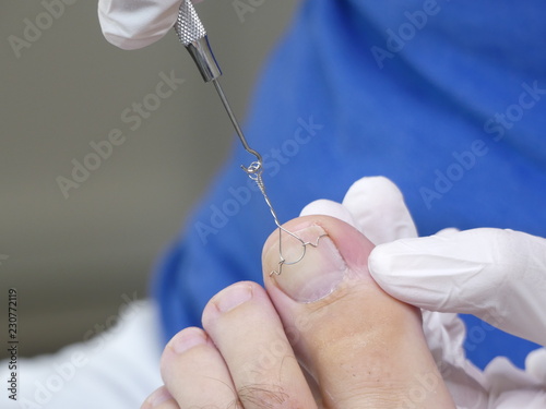 Fotografie Nagelspange, Orthonyxiespange bei einem eingewachsenen Nagel