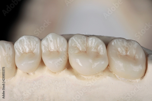 high quality ceramic Dental crowns, gum of the jaw photo