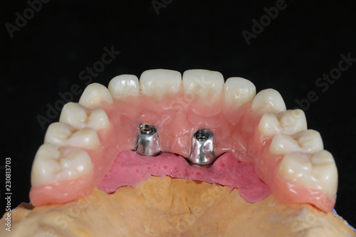 Temporary jaw model for precise orthopedics