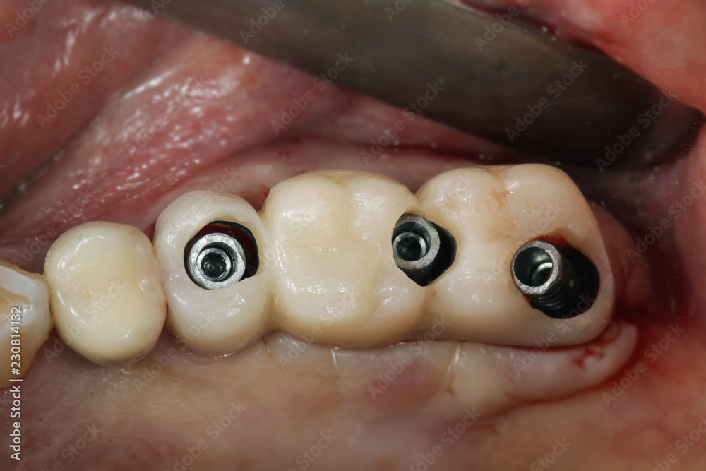 Obraz premium installation of crowns during surgery, intraoral photography