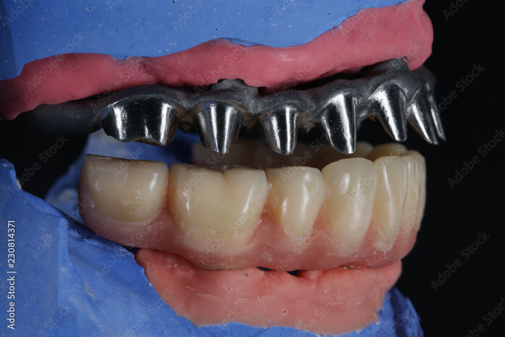 titanium and ceramic beam Dental prosthesis on the model, side view