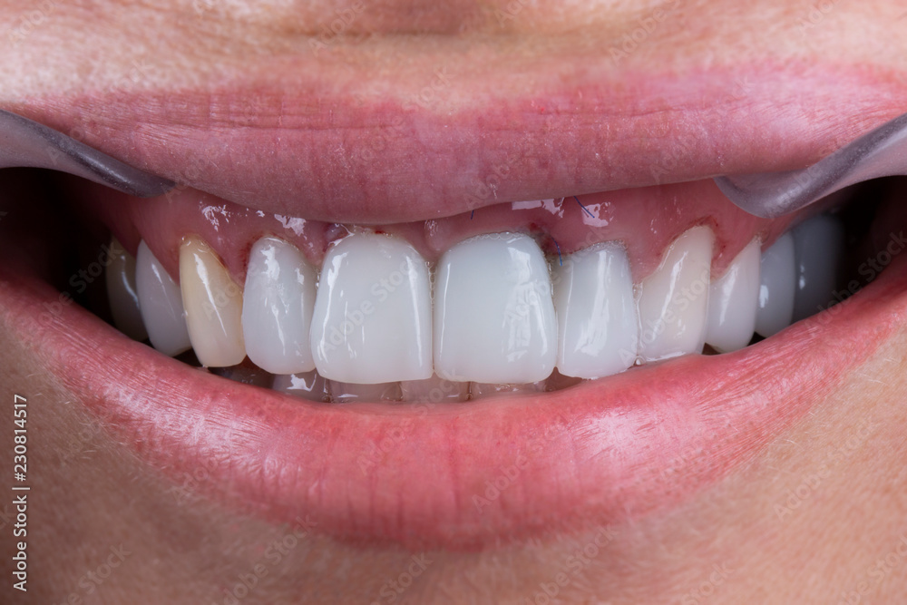 Fototapeta premium photo of the patient smiles with porcelain crowns on the central incisors