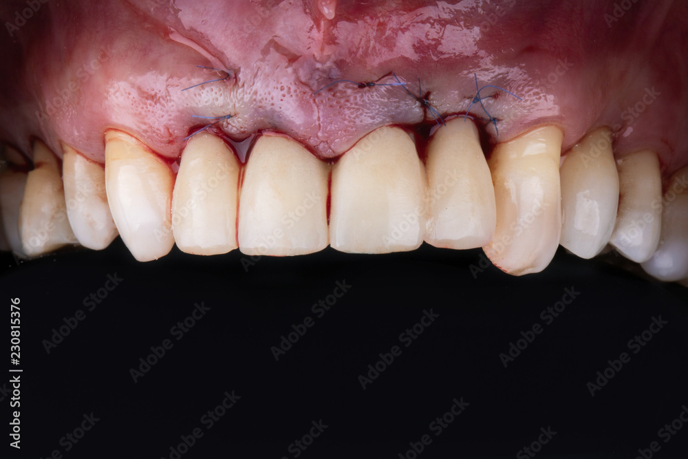 Four ceramic crowns, installed and tightened after final work Dental surgery